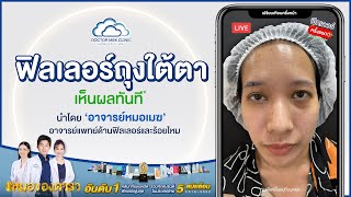 รีวิวจากคนไข้จริง - คุณวันใหม่ ฉีดฟิลเลอร์แก้ปัญหาถุงใต้ตา นำโดยอาจารย์หมอเมฆ ที่ DoctorMek Clinic