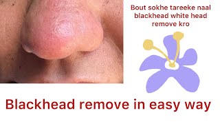 Easy way to remove black heads and white heads at home 🏠