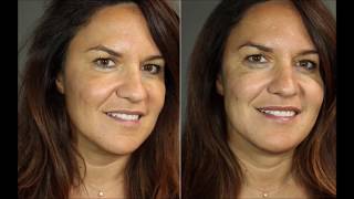 Dr. Nino Kuzmar Injects Juvederm in Cheeks \u0026 Marionettes