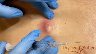 Infected cyst removal from the midback