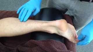 Dry Needling: Flexor Hallucis Longus