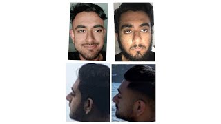 My journey to improve my facial structure