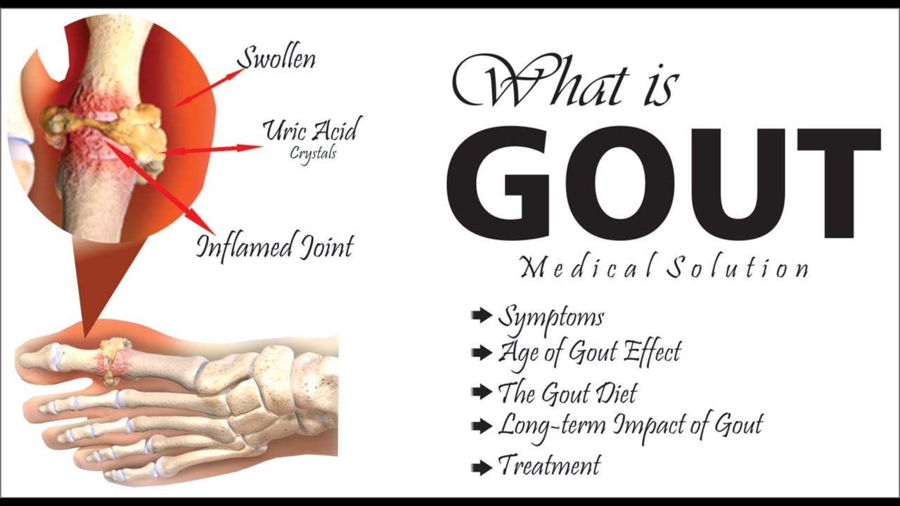 Gout Signs Symptoms And Complications