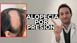 Alopecia por presión: los peligros de los procedimientos estéticos