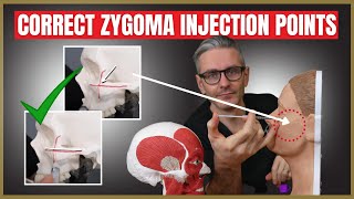 Injecting the Zygoma | Safety Advice & Injection Points