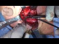 open repair of zenker s diverticulum