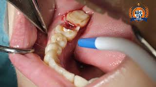 Simple, Easy \u0026 Effecint Extraction Technique- طریقه ساده و آسان کشیدن دندان