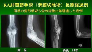 RA肘関節手術（滑膜切除術）術後15年経過症例　-リウマチ手の変形に対する再建手術も併用-