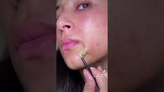 Pimple Popping Compilation ✨