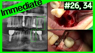 [Online Surgery] Maxillary immediate implant with CAS KIT \u0026 mandibular immediate implant with GBR