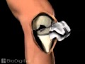 3D Medical Animation of a Knee Replacement