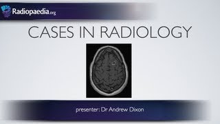 Cases in Radiology: Episode 1 (neuroradiology, CT, MRI)
