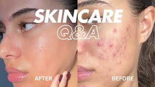 SKINCARE Q\u0026A - HOW I CLEARED MY ACNE | Jéssica Pimentel