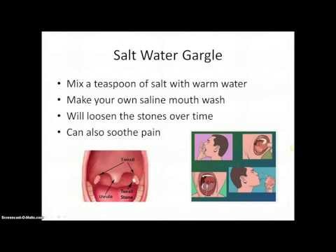 How To Get Rid Of Tonsil Stones How To Get Rid Of Tonsil Stones
