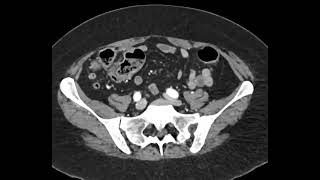 How to find the appendix on CT