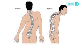 Skolyoz (Omurga Eğriliği) Nedir?