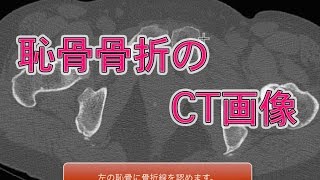 恥骨骨折のCT画像