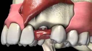 OsseoLink Dental Implant System Procedure Animation