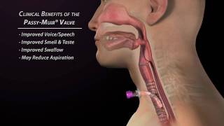 Clinical Benefits of the Passy Muir Valve
