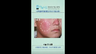 스테로이드 유발로 인해 생긴 주사/홍조 치료사례[프락셀부작용]