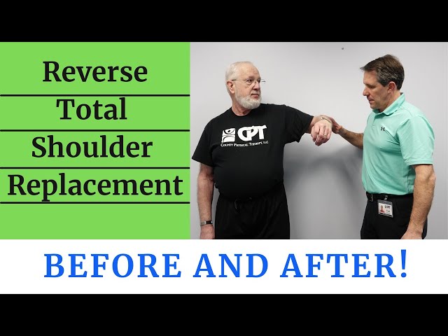 Reverse Total Shoulder Replacement Before After 55 Off
