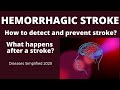 Hemorrhagic Stroke. How to detect and prevent strokes? What happens after a stroke?