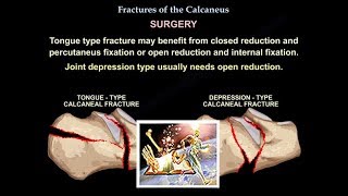 Fractures Of The Calcaneus - Everything You Need To Know - Dr. Nabil Ebraheim