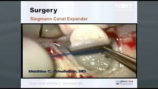 Canaloplasty with Stegmann Canal Expander  for Glaucoma