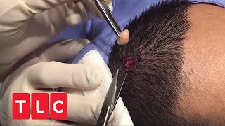 Junger Mann bekommt Talgzyste auf Kopfhaut ausgedrückt  | Dr. Pimple Popper | TLC Deutschland