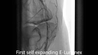 Superficial femoral artery angioplasty