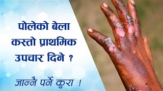 पोलेको बेला कस्तो प्राथमिक उपचार दिने | Burn First Aid