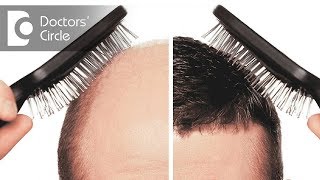 What is Hair Transplant? - Dr. Shivashankar B Sajjanshetty