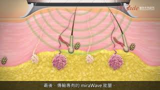 《miraDry清新微波止汗術》 MOA 作用原理