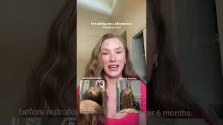 Hair Loss Alopecia treatment - Nutrafol Hair Growth Supplement Review #shorts