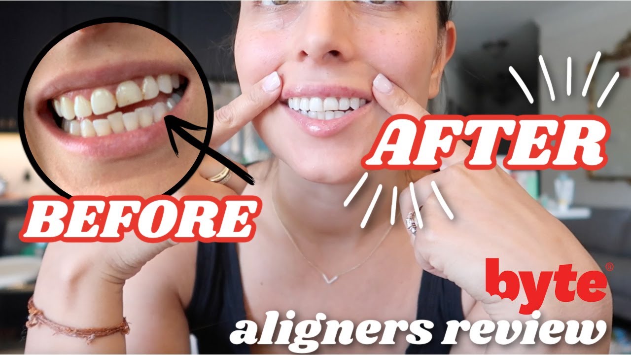 Byte Aligners Review Progress Byte Aligners Before After Youtube