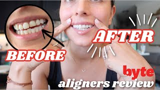 BYTE ALIGNERS REVIEW | progress + byte aligners before \u0026 after