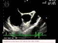 Recurrent Embolic Stroke Due to Nonbacterial Thrombotic Endocarditis Followed by Transesophageal Ech