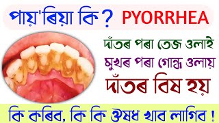 পায়'ৰিয়া কি কেনেকৈ চিকিৎসা কৰিব | pyria | periodontitis | pyorrhea treatment