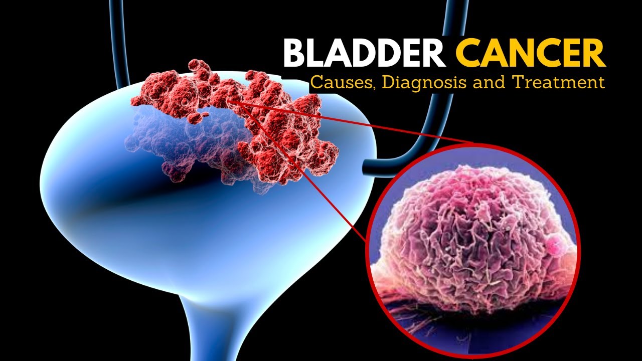 Bladder Cancer, Causes, Signs And Symptoms, Diagnosis And Treatment ...