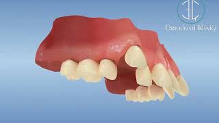Ortodontik Tedavide Üst Çeneden Diş Eksiltilerek Kanin Dişlerin Yerine Alınması