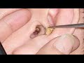 How To Remove Blackheads from Ear Relaxing Sounds
