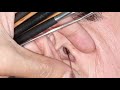 How To Remove Blackheads from Ear Relaxing Sounds