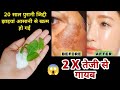 जिद्दी झाइयां हटाने का कमाल का तरीका | Reduce Melasma, Pigmentation, Discolouration, Blackspots