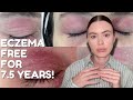 3 TIPS FOR HOW I CURED MY ECZEMA FOR 7.5 YEARS!