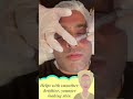 Microneedling Treatment at Dermacare Salon