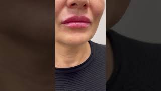 Russian Lip Filler JUVEDERM 1ml Rus Tekniği dudak dolgusu - Dermatolog Dr. Mustafa TÜMTÜRK