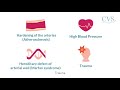 cvskl abdominal aortic aneurysm aaa education video