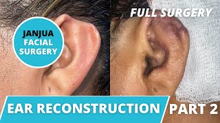 EAR RECONSTRUCTION SURGERY ON MISSING UPPER EAR | PART 2 - DR. TANVEER JANJUA - NEW JERSEY