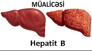 Hepatit B dərmansız sağalır? - Həkimdən açıqlama