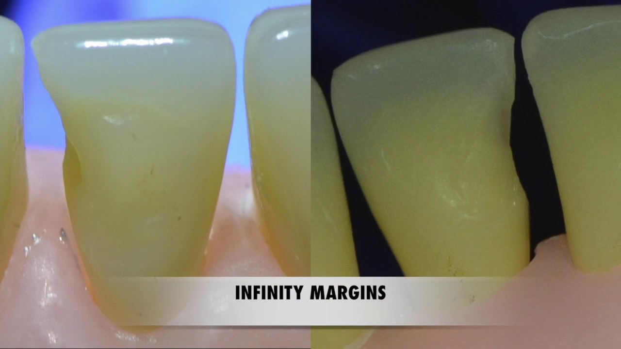 Class III Cavity Preparation For Resin Composite - YouTube